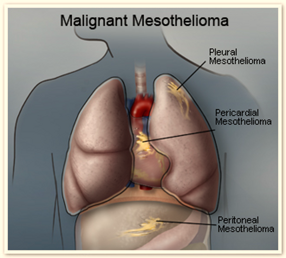 Malignant Mesothelioma Malignant Mesothelioma