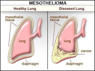 Mesothelioma simplified - lung with mesothelioma Mesothelioma simplified - lung with mesothelioma