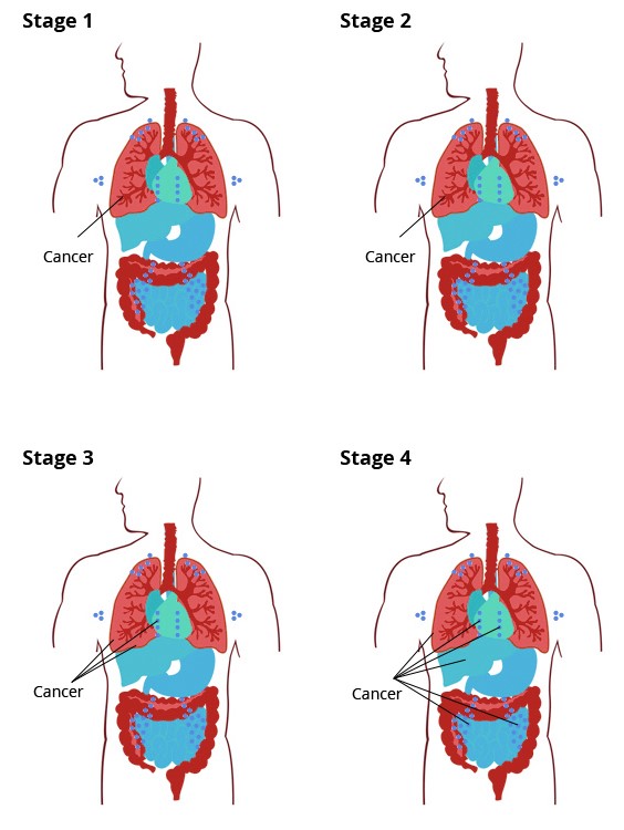 TNM Staging System - Cancer presence per stage TNM Staging System - Cancer presence per stage